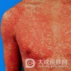 药物性皮炎的发病特点
