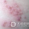 生殖器疱疹能治愈吗？