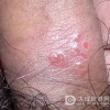 生殖器疱疹都有哪些症状？
