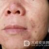 药疹药物性皮炎的形态是怎样的