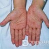 常见梅毒疹的类型有哪些？