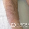 胫前粘液性水肿如何预防