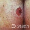痈肿的皮损特点是什么呢?