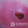 应该如何防止颈痈发生