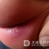痈肿的症状特点都有哪些呢?