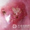 严重痈患者应做的坚持项目