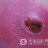 痈的发病机制有什么呢?