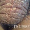 阴囊湿疹发生原因有哪些?
