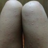 急性荨麻疹危害都有哪些