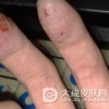 手癣可以怎样来诊治