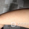 得了风疹我们应该怎么办呢
