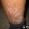 染发皮炎要怎么护理