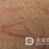 丘疹荨麻疹症状是如何发作的呢