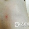 鲜红斑痣是什么原因引起的