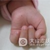 鲜红斑痣的形成原因是什么
