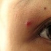 常见鲜红斑痣的症状是什么