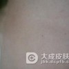 面部鲜红斑痣的危害有哪些