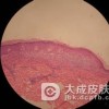 扁平苔藓的病因是什么