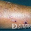 结节性痒疹的疾病症状有哪些