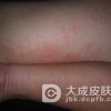丘疹性荨麻疹的危害