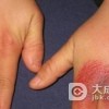 怎样才可以预防冻疮发生呢