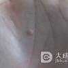 儿童得了寻常疣怎么办