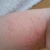 夏季皮炎的预防
