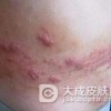 带状疱疹患者正确认识自己的疾病