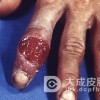 三期梅毒有什么严重危害