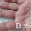 生殖器疱疹该怎么进行诊断