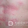 得荨麻疹都需要注意些什么