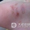 水泡型脚气的护理注意事项