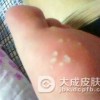 脚部干裂脱皮和脚气有关系吗
