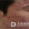 什么导致了脂溢性皮炎