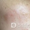 怎么护理得了脂溢性皮炎的皮肤