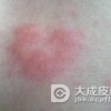 小孩子荨麻疹的皮肤护理知识有哪些呢