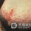 男性患上淋病会发生哪些迹象
