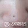 快速有效去除黑头粉刺的方法