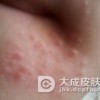 粉刺皮肤的八大护理方法