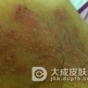 梅毒发病三期有哪些症状
