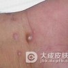 结节性梅毒疹治疗