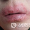 面部干性湿疹有什么症状