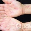 如何护理好淋病促进更好的康复