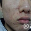 寻常痤疮的病理性分析