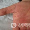 手足癣怎么可以彻底治疗好