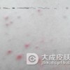 丘疹荨麻疹症状是如何发作的