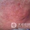 蔬菜也会引起日光性皮炎吗