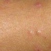 结节性痒疹的症状特点有什么