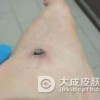 寻常疣的治疗偏方有哪些