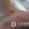 生活中寻常疣要注意什么